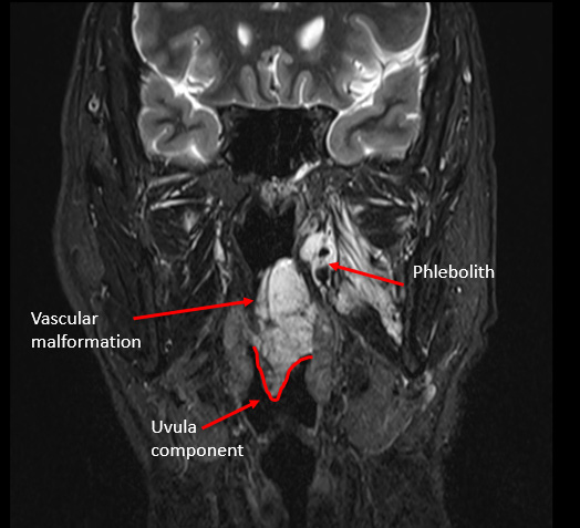 RF Ablation as 1st line treatment for head & neck vascular malformation