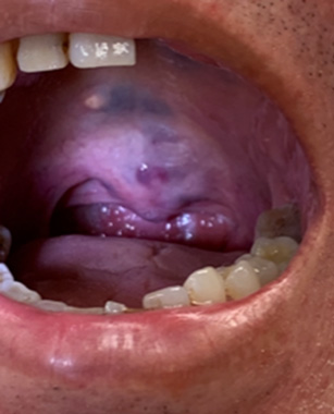 RF Ablation as 1st line treatment for head & neck vascular malformation