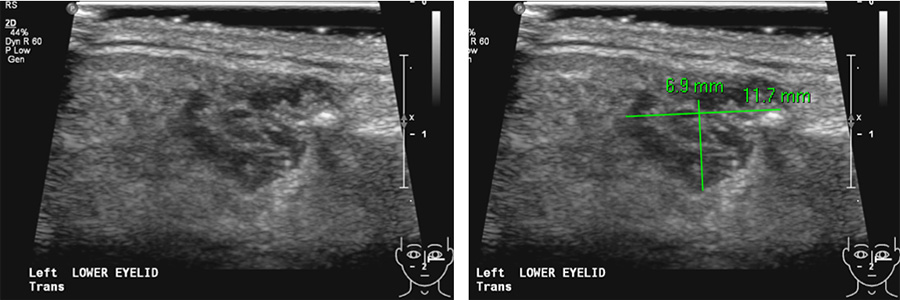 RF Ablation as 1st line treatment for head & neck vascular malformation