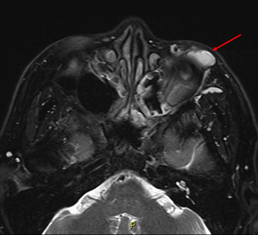 RF Ablation as 1st line treatment for head & neck vascular malformation