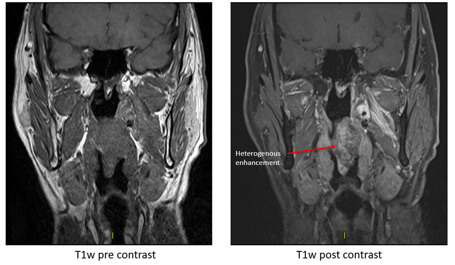 RF Ablation as 1st line treatment for head & neck vascular malformation