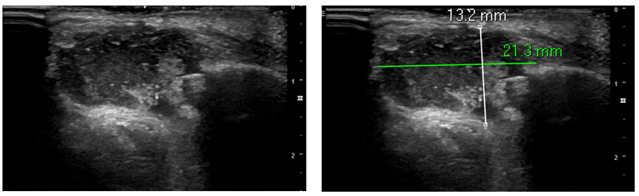 RF Ablation as 1st line treatment for head & neck vascular malformation