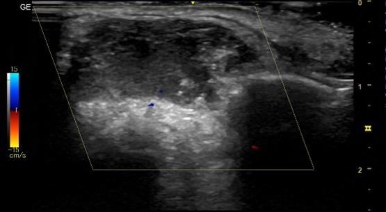 RF Ablation as 1st line treatment for head & neck vascular malformation