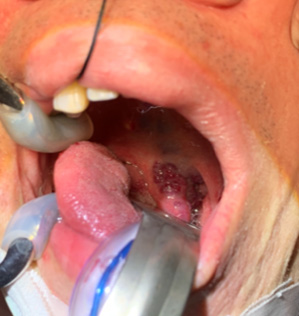 RF Ablation as 1st line treatment for head & neck vascular malformation