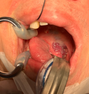 RF Ablation as 1st line treatment for head & neck vascular malformation