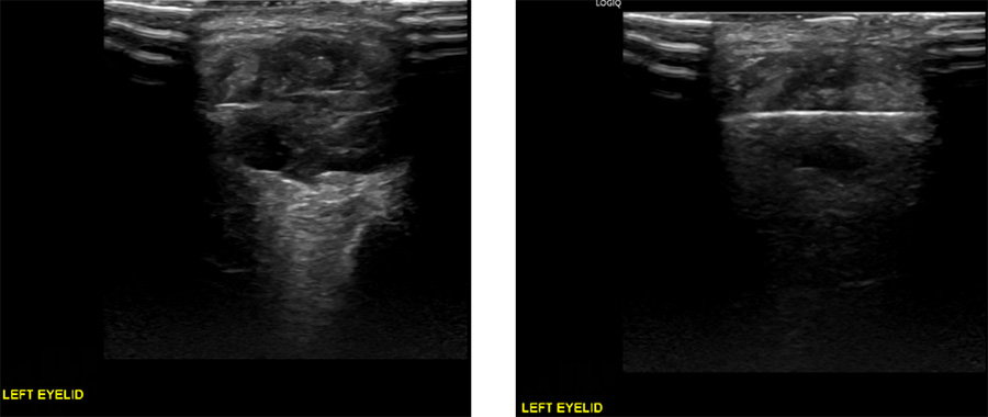 RF Ablation as 1st line treatment for head & neck vascular malformation